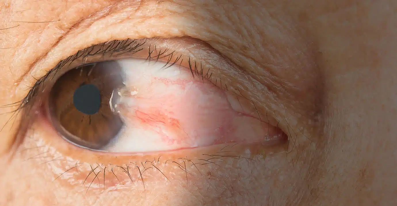 Pterigion: crecimiento conjuntival cornea eoftalmo pterigion-crecimiento-conjuntival-cornea-eoftalmo