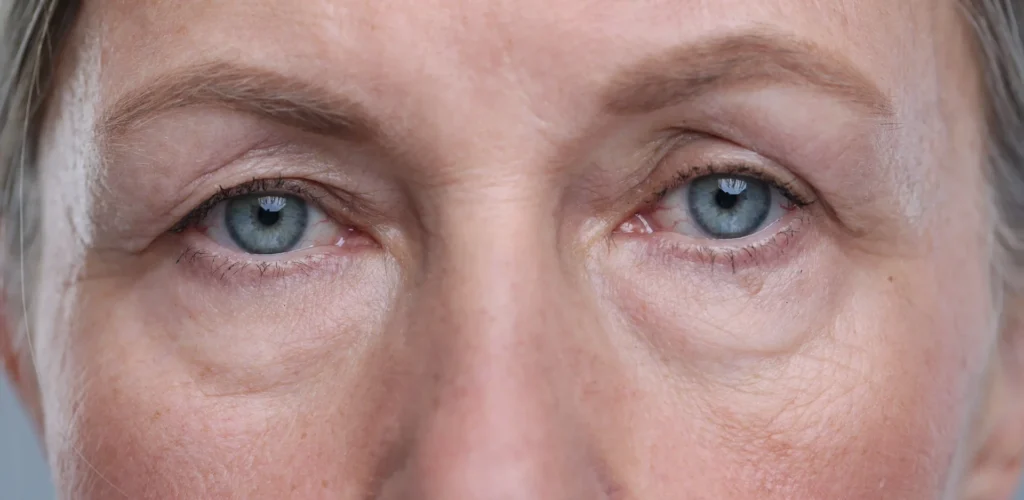 Párpados caídos por ptosis palpebral  aponeurótica (ptosis senil) relacionada con la edad.