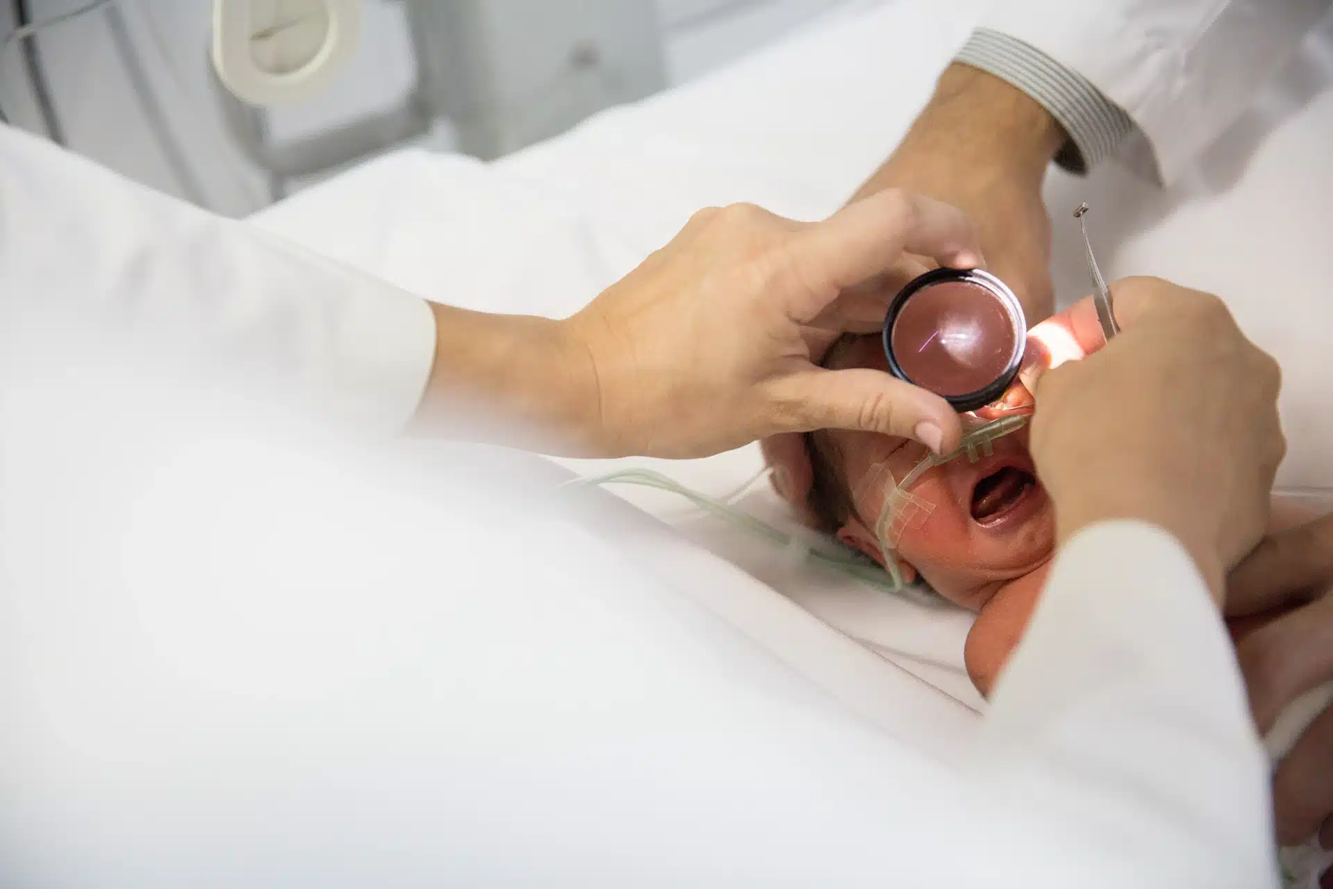 retinopatia-del-prematuro-screening-oftalmoscopia-neonatologia-eoftalmo Screening de retinopatía del prematuro mediante oftalmoscopía indirecta en bebé internado en neonatología.