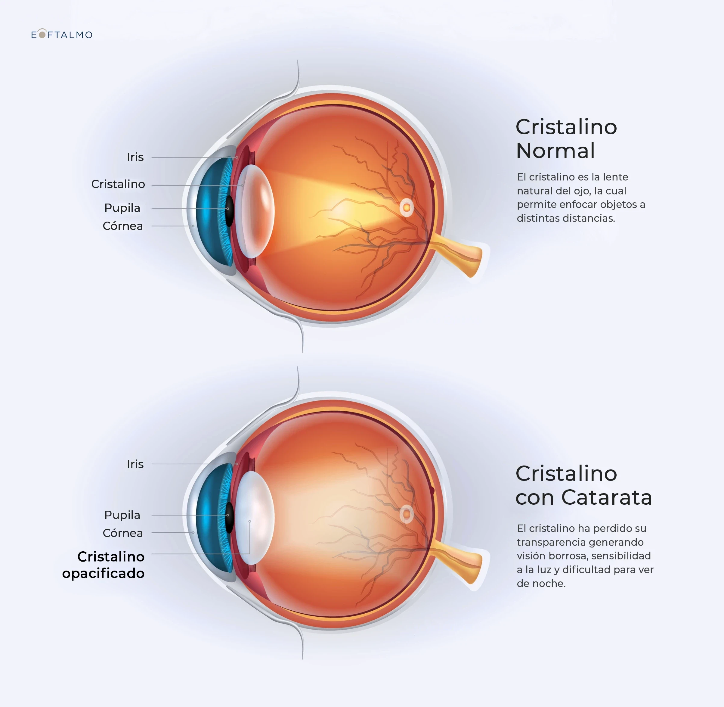 Cuándo se recomienda la Cirugía de Cataratas. Ilustración médica de un ojo sano y uno con cristalino opacificado por Catarata.
