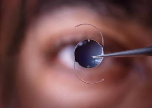 Cirugía de cataratas: Implante de lente intraocular LIO