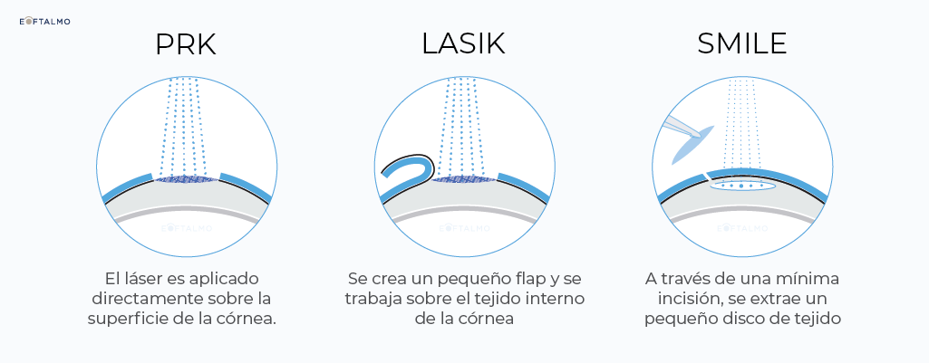 Eoftalmo Diagrama de técnicas disponibles en Cirugía Refractiva en San Juan