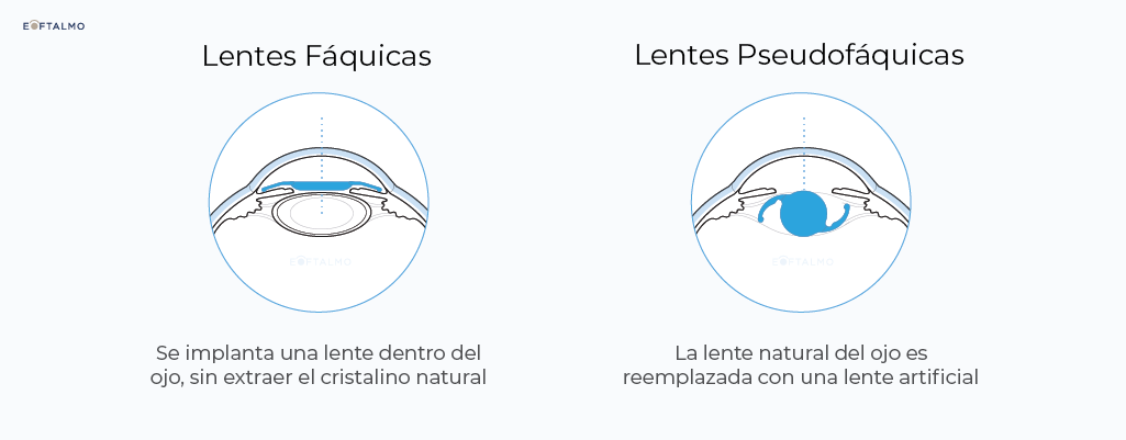 Eoftalmo Diagrama de técnicas disponibles para Implantes Intraoculares (ICL/IPCL) en San Juan