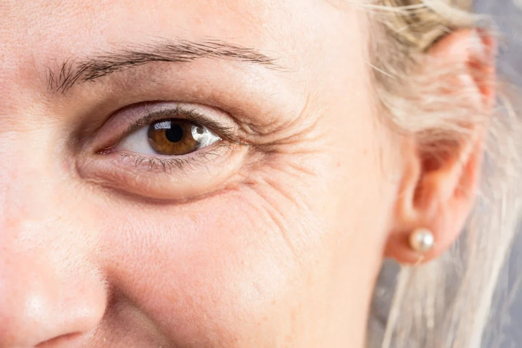 Paciente de tratamiento de oculoplastia con signos de envejecimiento periocular: bolsas grasas en el párpado inferior, flacidez cutánea y arrugas de expresión en el contorno de ojos