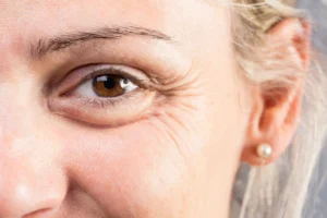 Paciente de tratamiento de oculoplastia con signos de envejecimiento periocular: bolsas grasas en el párpado inferior, flacidez cutánea y arrugas de expresión en el contorno de ojos